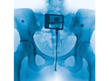 Charger l&#39;image dans la galerie, Radiographie du bassin avec un dispositif médical. Le dispositif a un cadre carré et une tige longue et nervurée.
